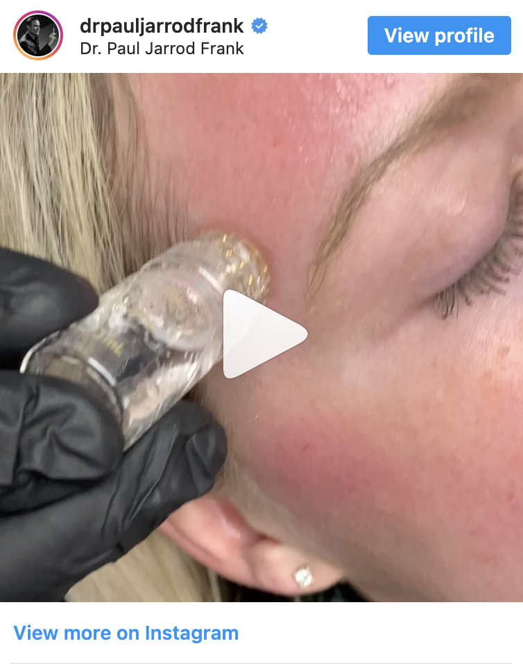 Aquagold procedure video by Dr. Paul Jarrod Frank of PFRANKMD in New York City, NY