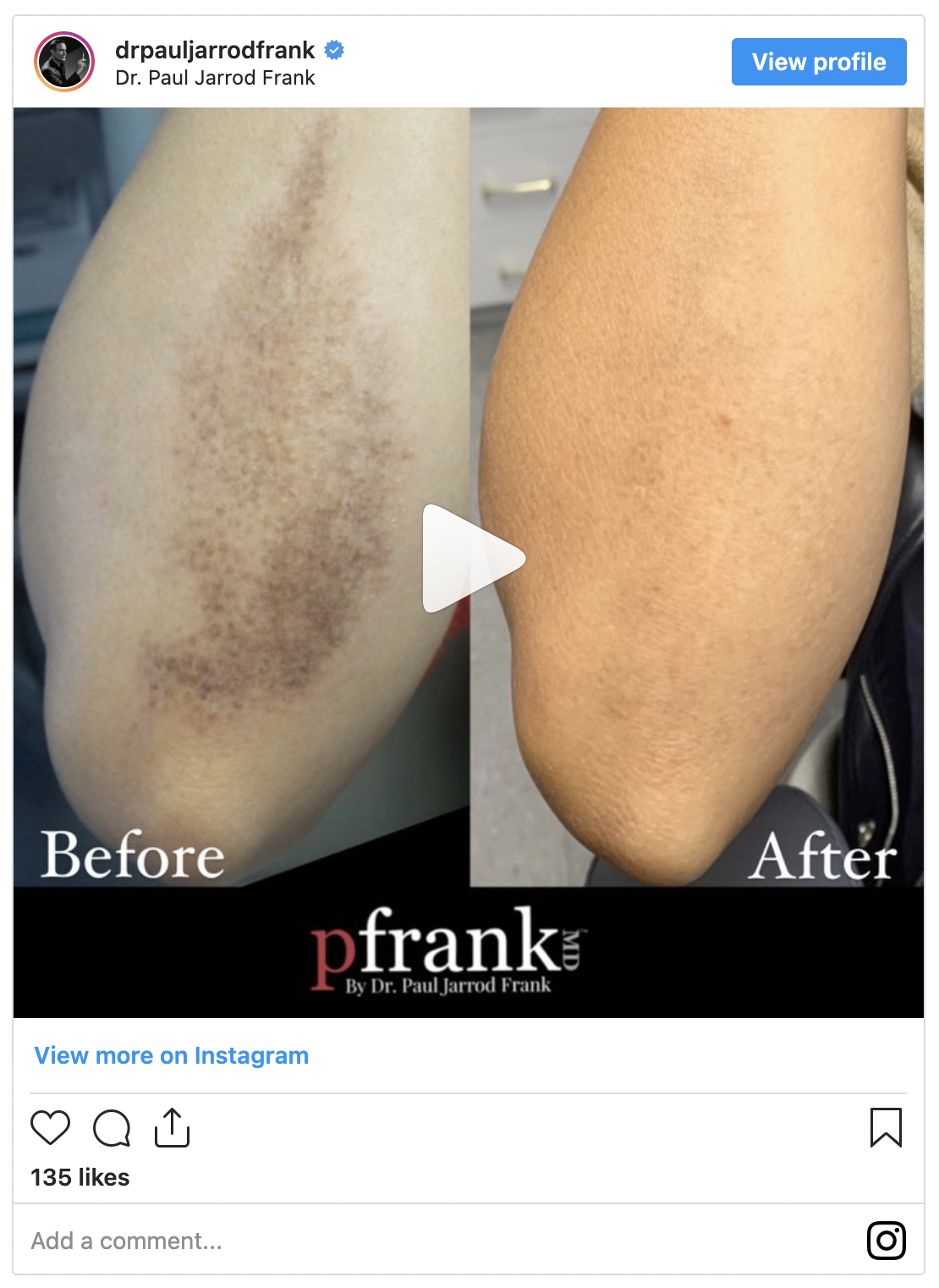 Skin Discoloration Before and After video by Dr. Paul Jarrod Frank of PFRANKMD in New York City, NY
