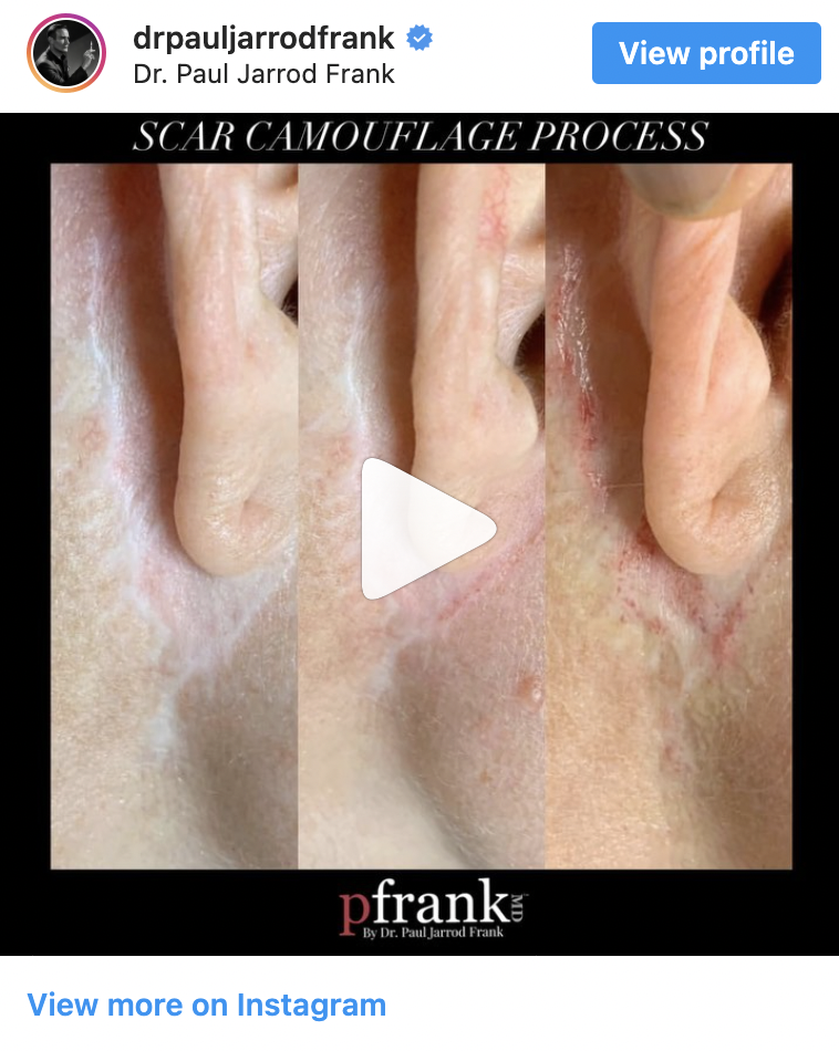 Scar Camouflage Process by Dr. Paul Jarrod Frank of PFRANKMD in New York City, NY