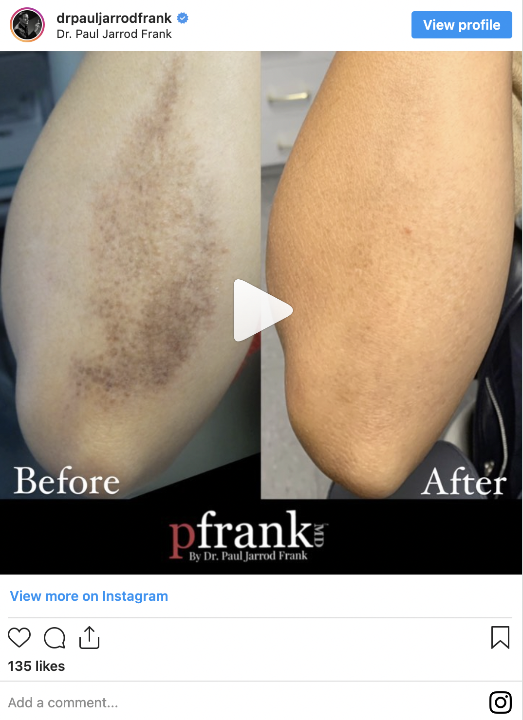 Scars Before and After photo by Dr. Paul Jarrod Frank of PFRANKMD in New York City, NY