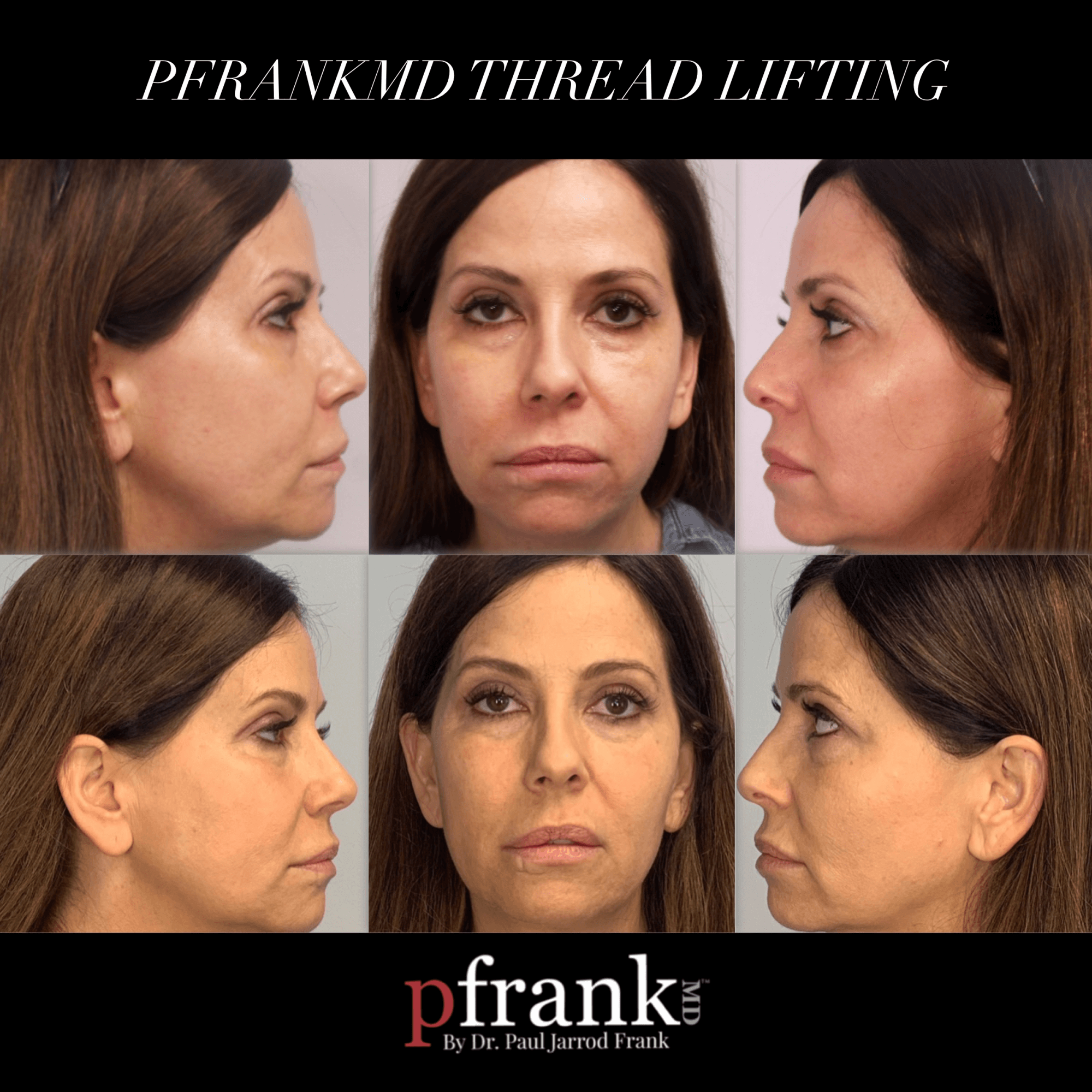 ThreadLift Before and After photos by Dr. Paul Jarrod Frank of PFRANKMD in New York City, NY