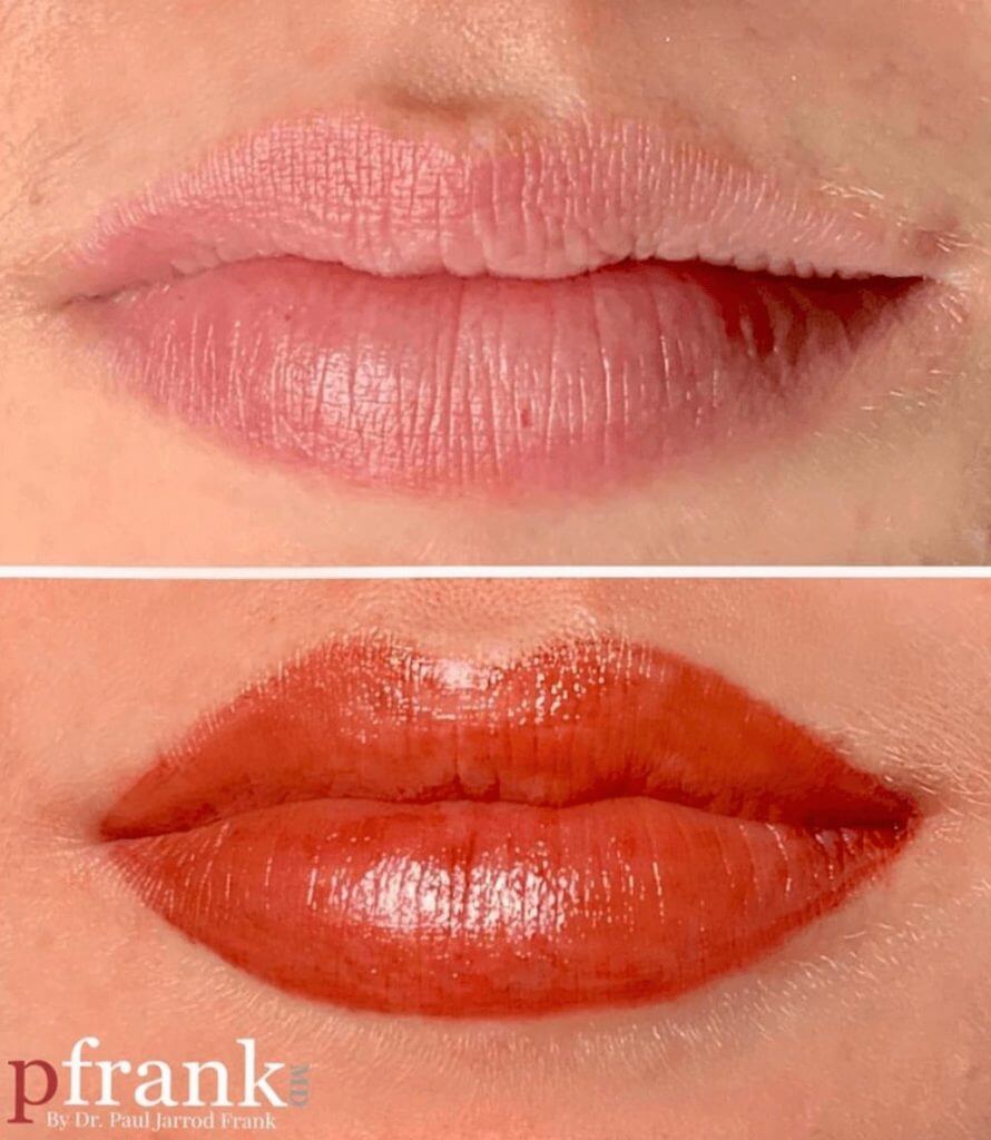 Permanent Makeup Before and After photo by Dr. Paul Jarrod Frank of PFRANKMD in New York City, NY