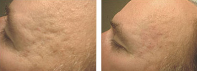 Acne Scars Before and After photo by Dr. Paul Jarrod Frank of PFRANKMD in New York City, NY
