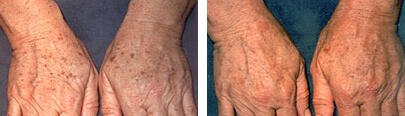 Age Spots Laser Treatment Before and After photo by Dr. Paul Jarrod Frank of PFRANKMD in New York City, NY
