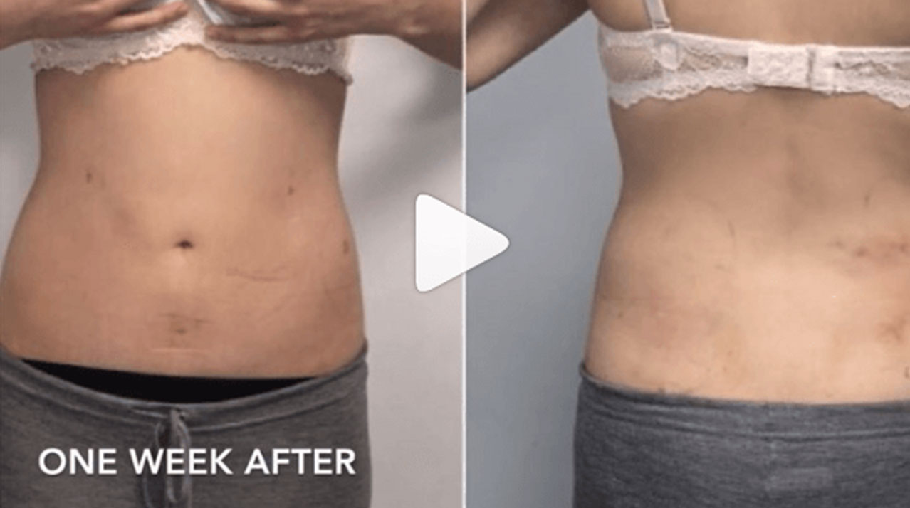 Body Contouring Before and After photo by Dr. Paul Jarrod Frank of PFrankMD in New York City, NY
