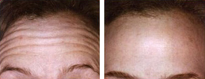 Botox Before and After photo by Dr. Paul Jarrod Frank of PFRANKMD in New York City, NY