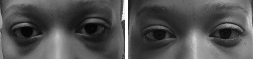 Dark Eye Circles Before and After photo by Dr. Paul Jarrod Frank of PFRANKMD in New York City, NY