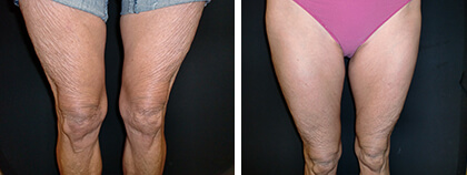 Exilis Before and After photo by Dr. Paul Jarrod Frank of PFRANKMD in New York City, NY