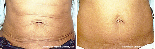 Exilis Before and After photo