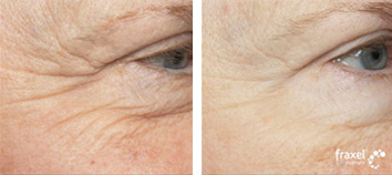 Fraxel Before & After photo by Dr. Paul Jarrod Frank of PFRANKMD in New York City, NY