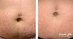 Fraxel Before & After photo by Dr. Paul Jarrod Frank of PFRANKMD in New York City, NY