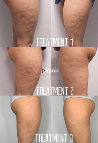 BIOSTIM Treatment Before and After photo by Dr. Paul Jarrod Frank of PFRANKMD in New York City, NY