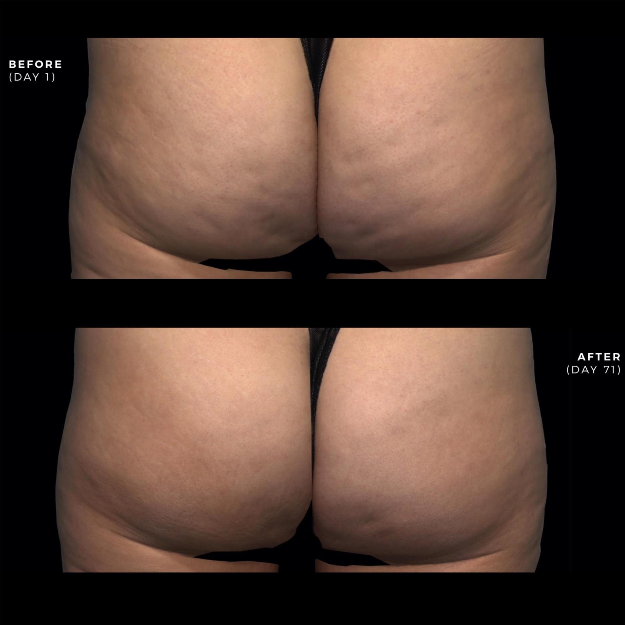 QWO Before and After photo by Dr. Paul Jarrod Frank of PFRANKMD in New York City, NY