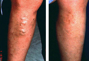 Leg Veins Before and After photo by Dr. Paul Jarrod Frank of PFRANKMD in New York City, NY