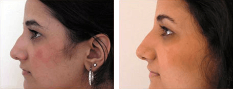 Non-Surgical Nose Job Before and After photo by Dr. Paul Jarrod Frank of PFRANKMD in New York City, NY