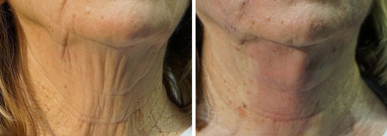 NovaThreads for Sagging Neck Before and After photo by Dr. Paul Jarrod Frank of PFRANKMD in New York City, NY