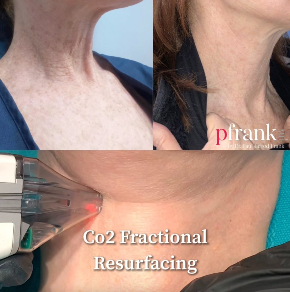 Skin Resurfacing Before & After photo by Dr. Paul Jarrod Frank of PFrankMD in New York City, NY