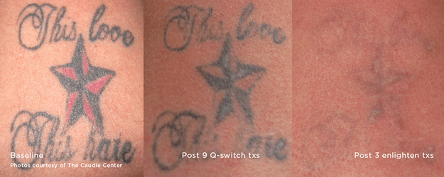 Tattoo Removal Before and After photo by Dr. Paul Jarrod Frank of PFRANKMD in New York City, NY