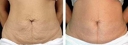 Thermage Before and After photo by Dr. Paul Jarrod Frank of PFRANKMD in New York City, NY