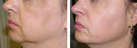 Thermage Thermalift Before and After photo by Dr. Paul Jarrod Frank of PFRANKMD in New York City, NY
