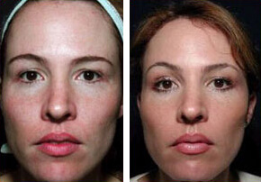 Thermalift Before and After photo by Dr. Paul Jarrod Frank of PFRANKMD in New York City, NY