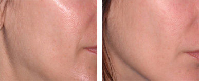 Ultherapy Before and After photo by Dr. Paul Jarrod Frank of PFRANKMD in New York City, NY