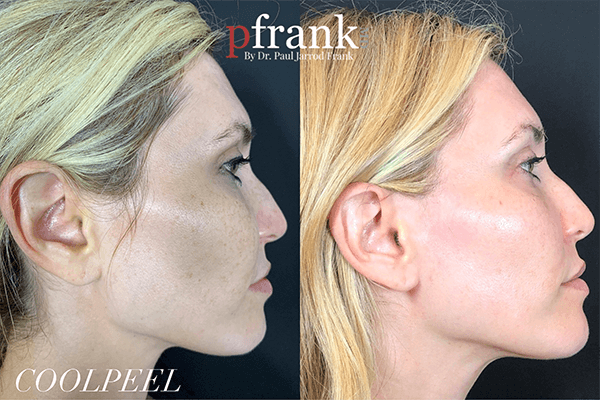 Coolpeel Before and After photo by Dr. Paul Jarrod Frank of PFRANKMD in New York City, NY