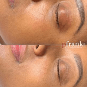 BB Glow Up Before & After photo by Dr. Paul Jarrod Frank of PFRANKMD in New York City, NY