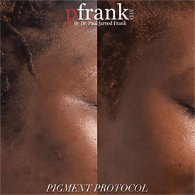 Pigment Protocol Before and After photo by PfrankMD in New York City, NY