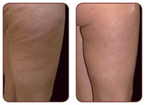 VASERsmooth Before and After photo by Dr. Paul Jarrod Frank of PFRANKMD in New York City, NY