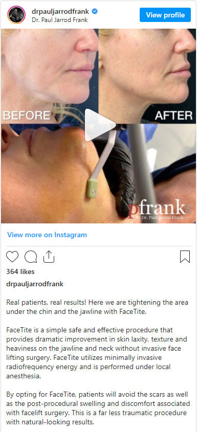 FaceTite treatment by Dr. Paul Jarrod Frank of PFRANKMD in New York City, NY