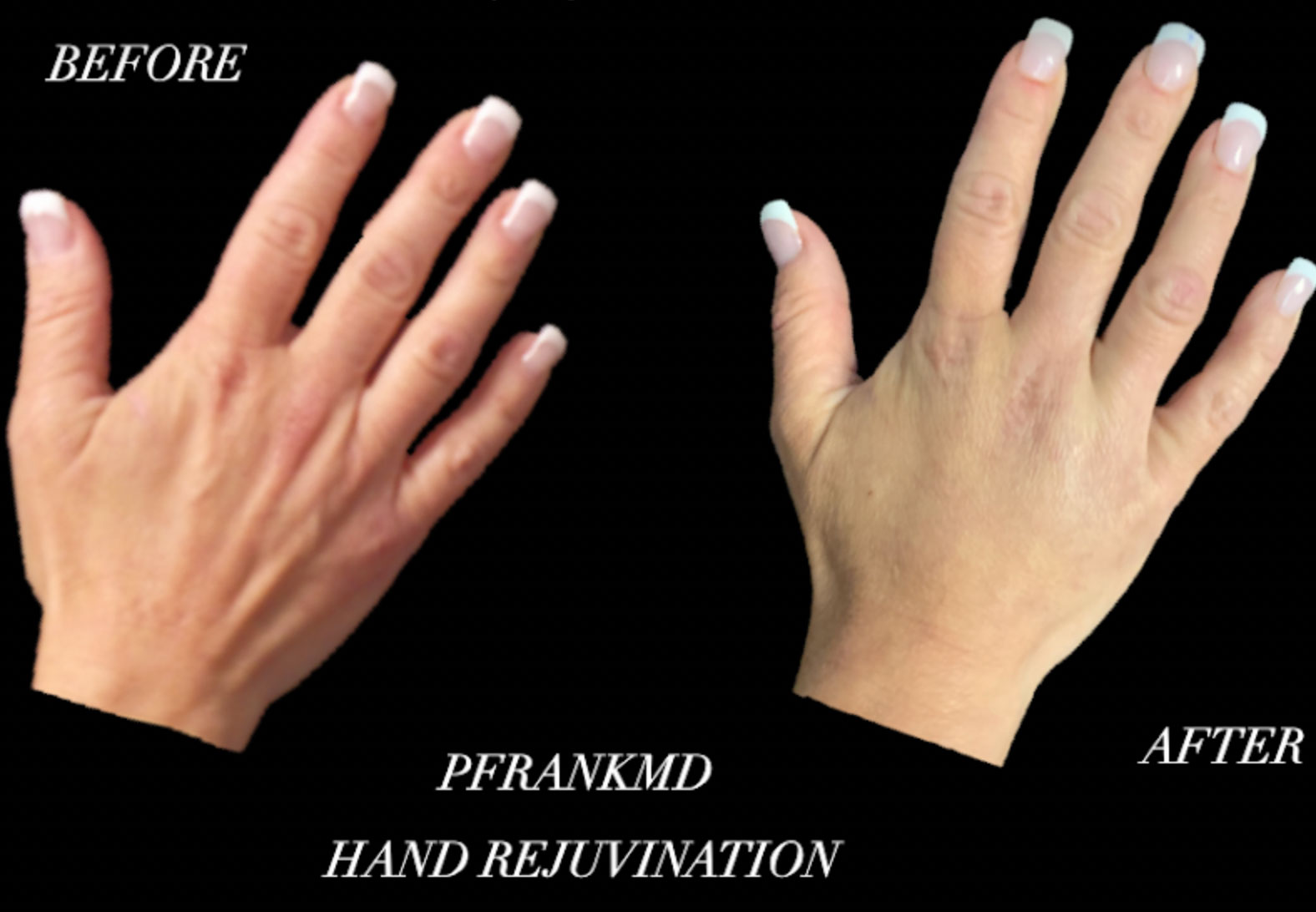 PFRANKMD - Hand Rejuvenation