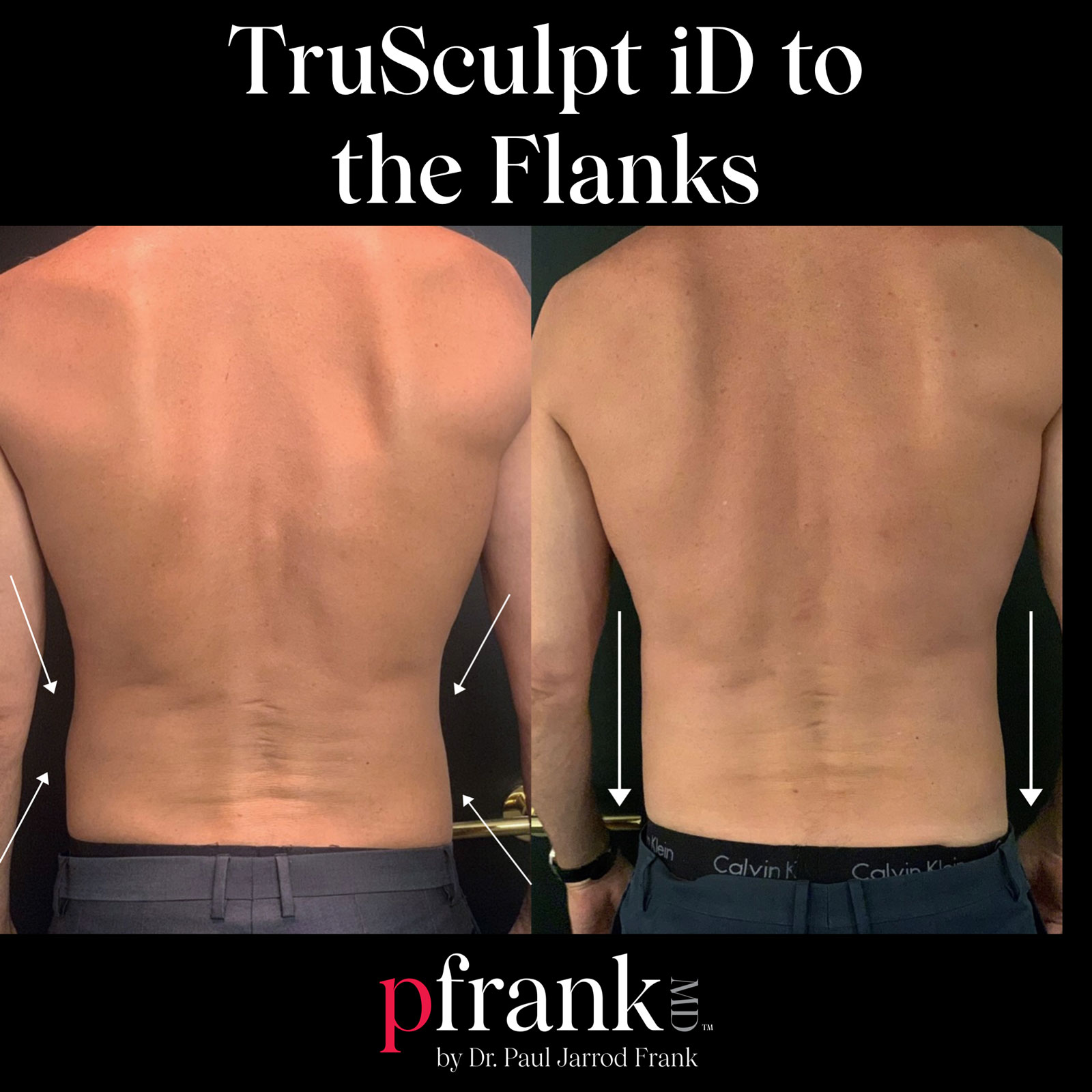 TruSculptiD Before and After Photo by Dr. Frank in New York, NY