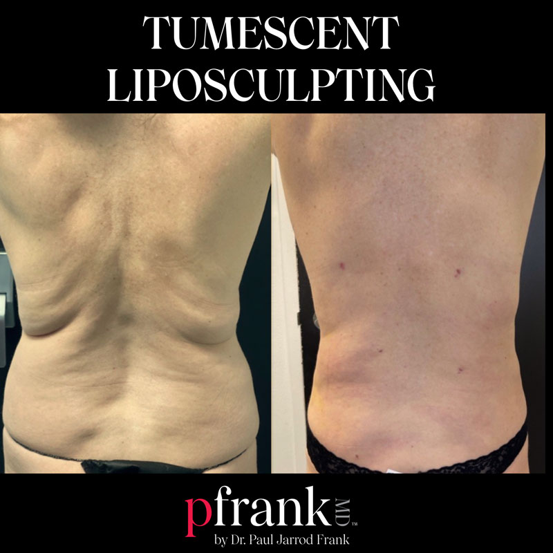 Tumescent Liposculpting - PFrank MD