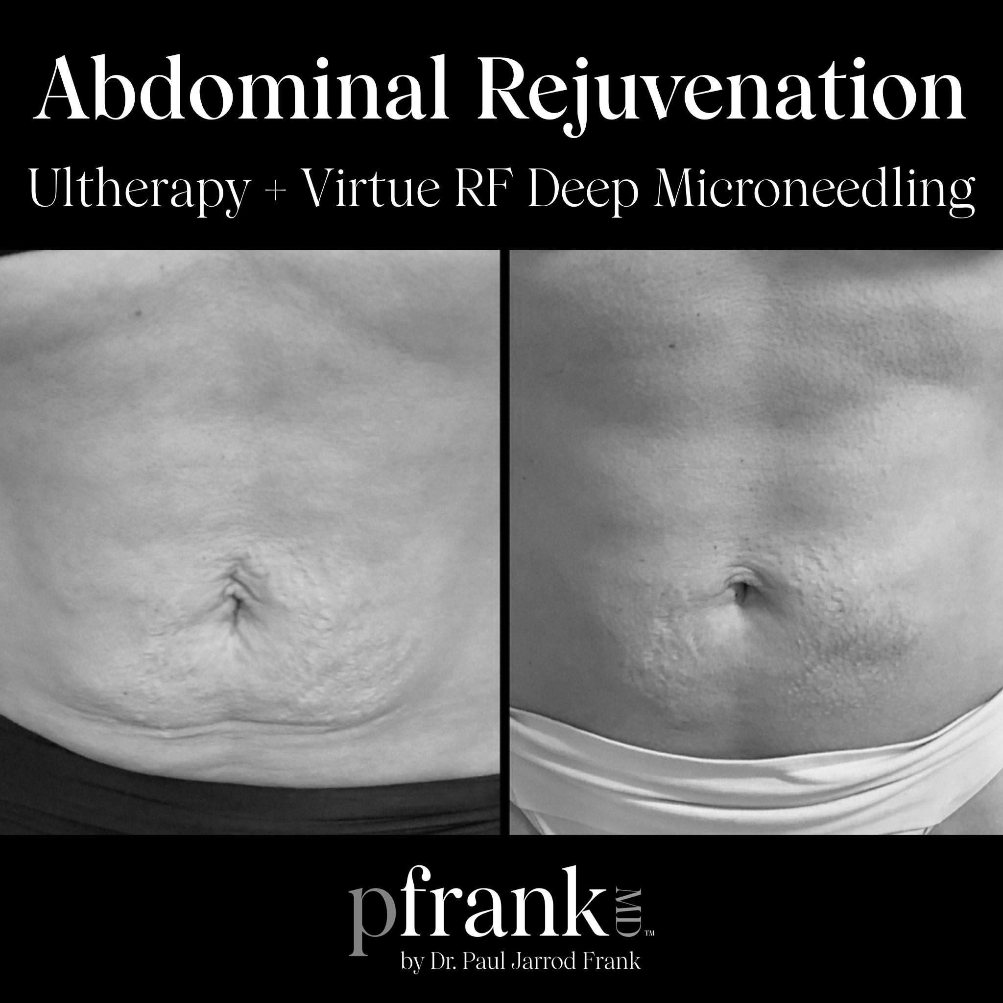 abdominal rejuvenation microneedling before and after