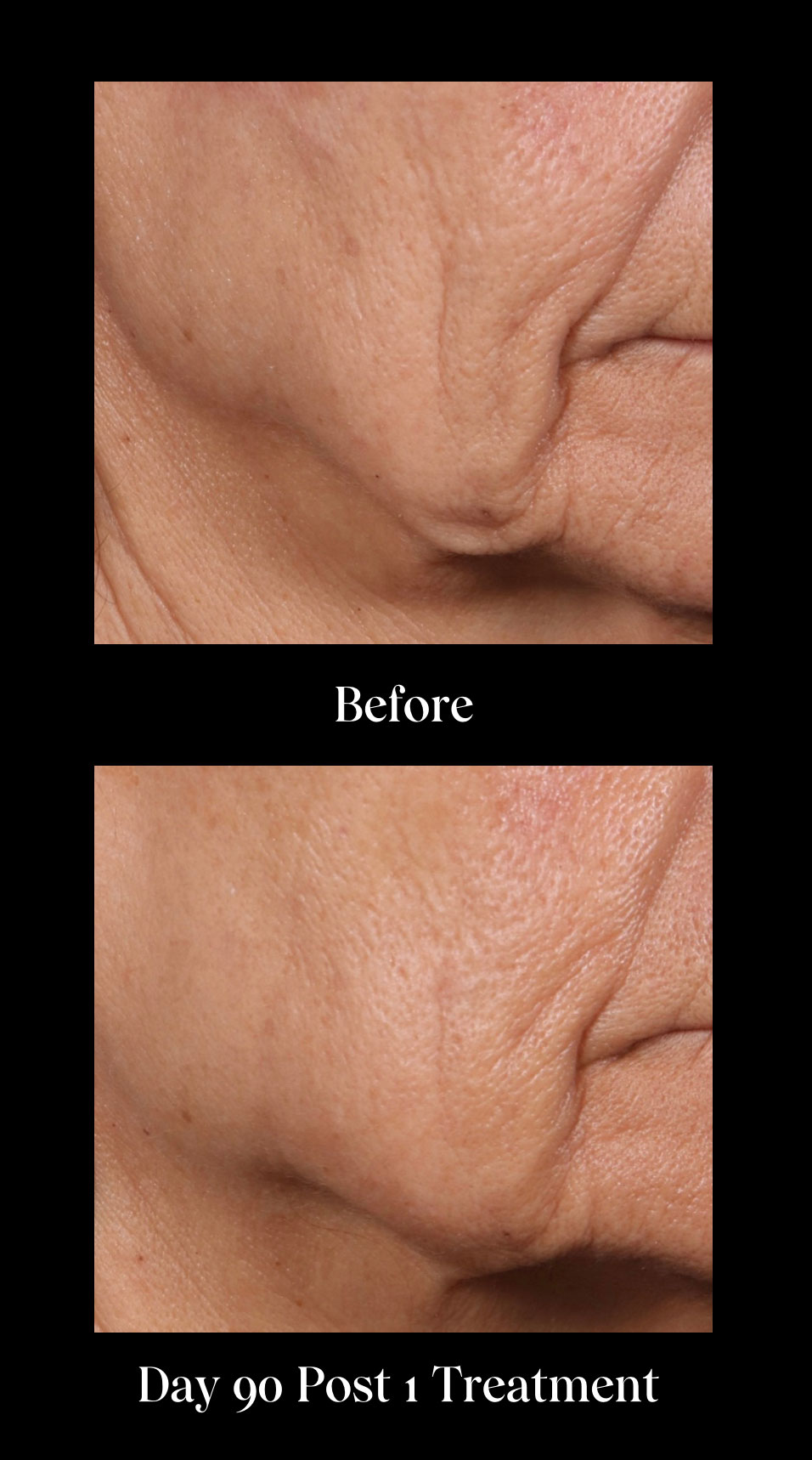 pfrankmd ellacor before after