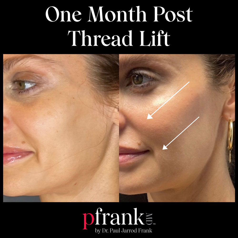 pfrankmd thread lift before and after