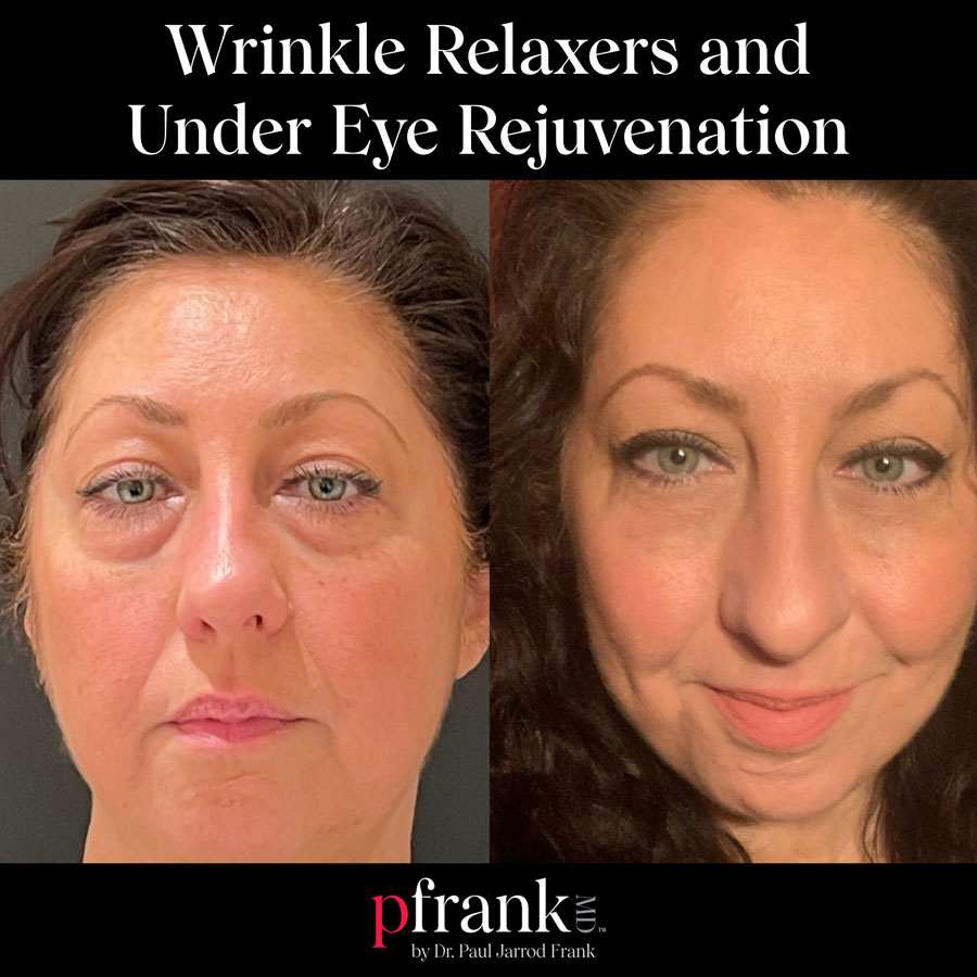 Wrinkle Relaxers Before and After