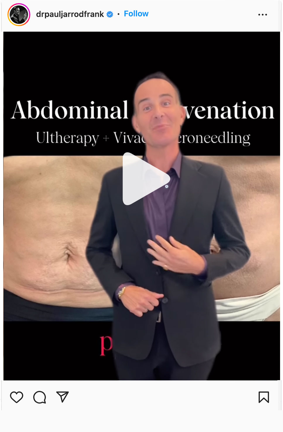abdominal rejuvenation