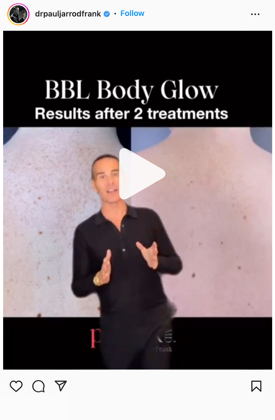 bbl body glow explained