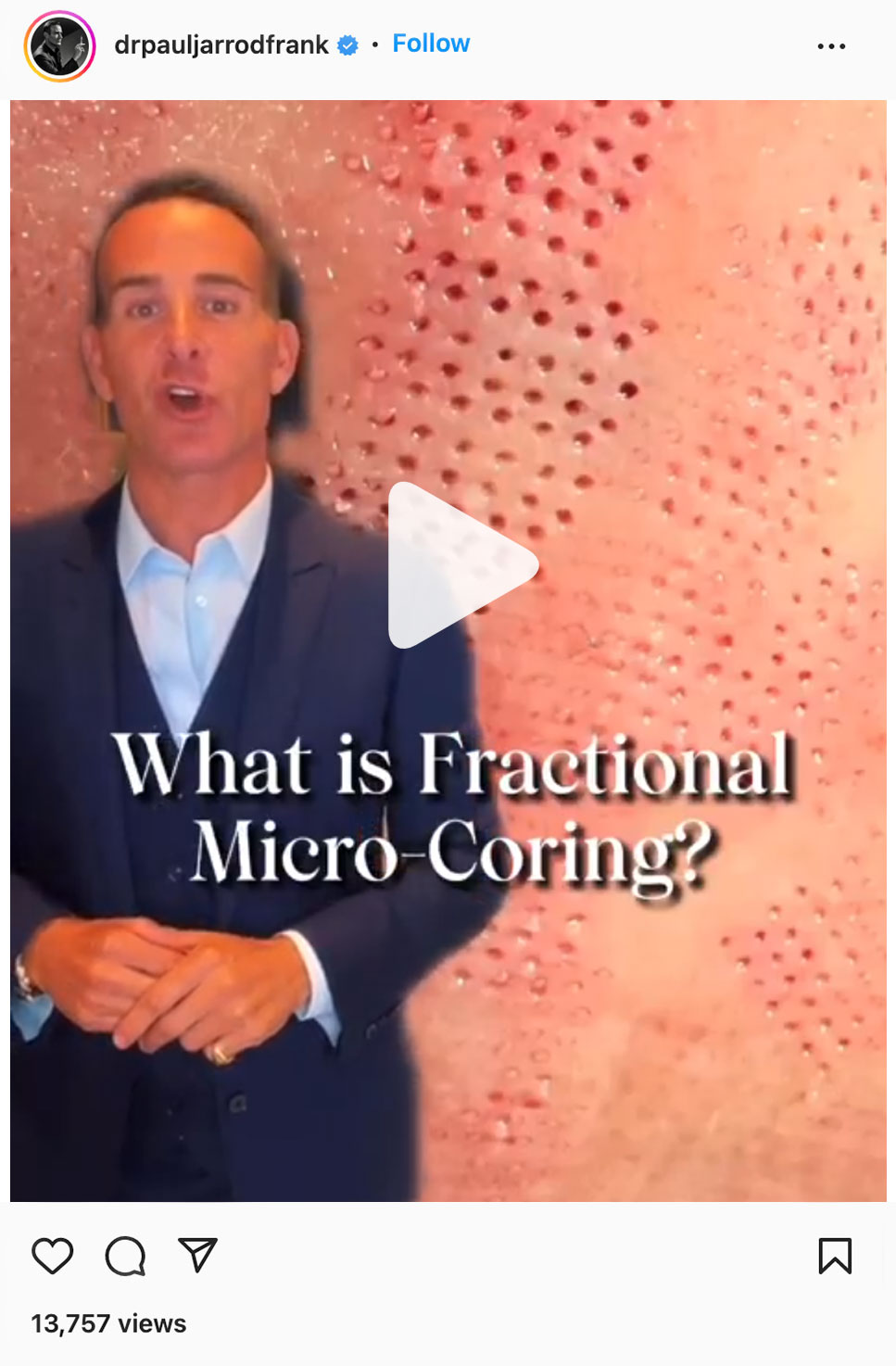 fractional micro-coring