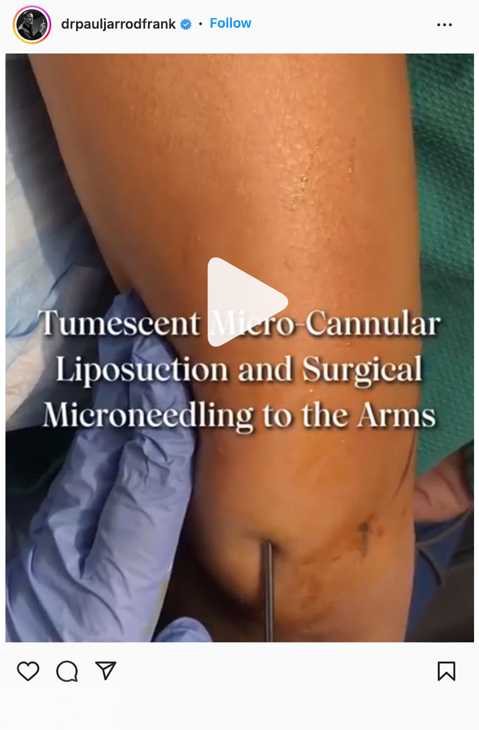tumescent micro-cannular liposuction