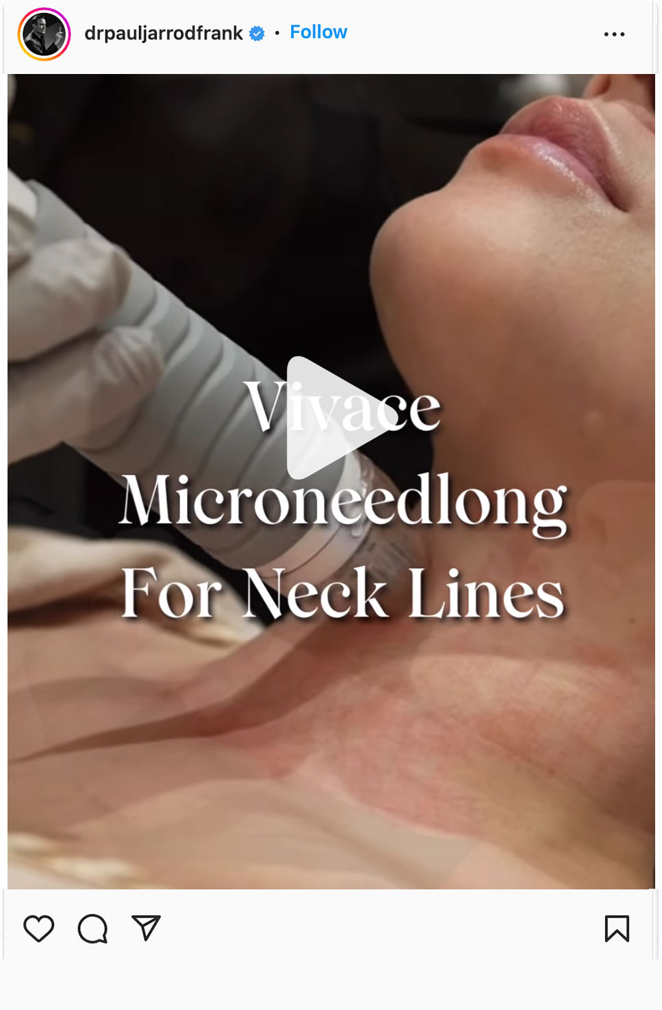 vivace microneedling neck
