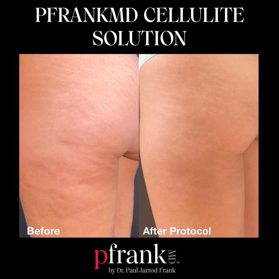 Cellulite Solution Before and After