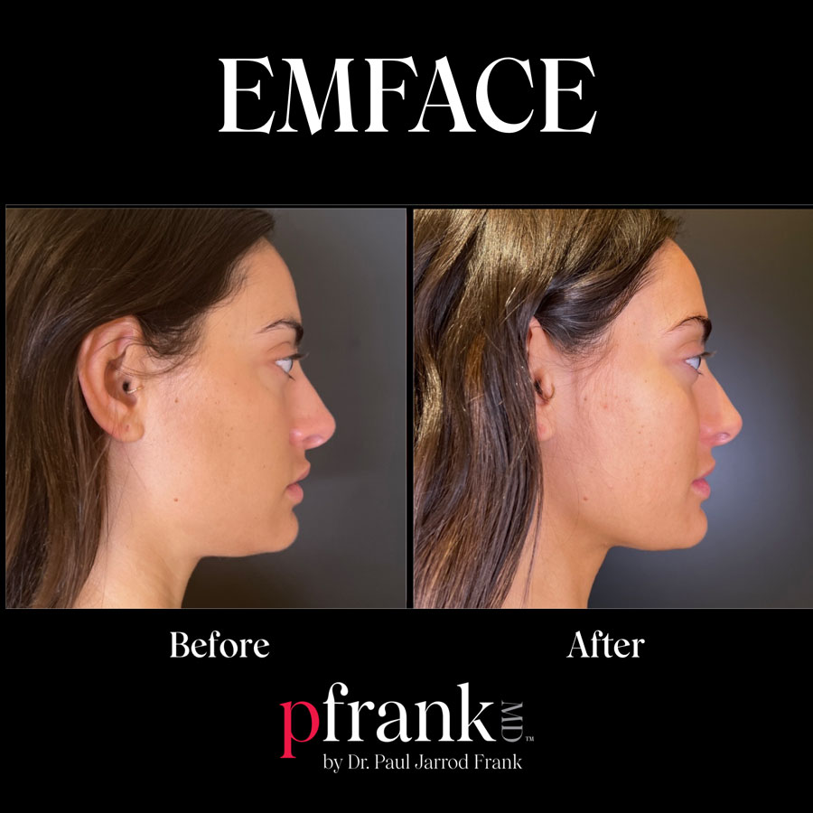EMFACE Before& After