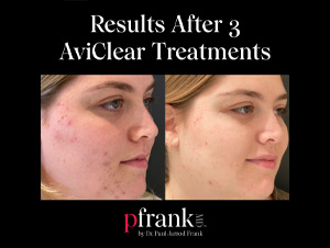 Aviclear Before and After Results