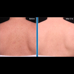 BBL Body Glow Before and After Results