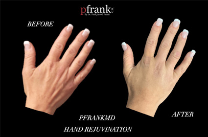 Aging Hands Before and After Results