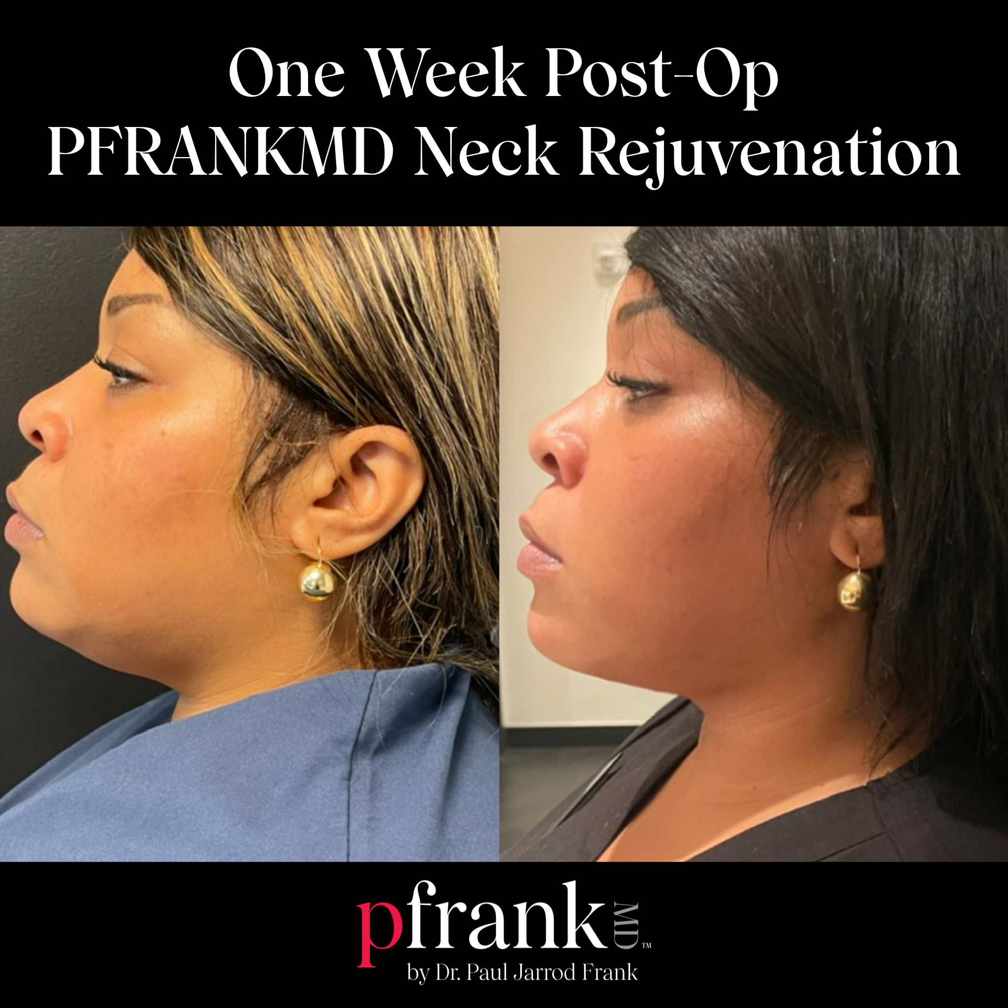 Neck Rejuvenation Before and After Results