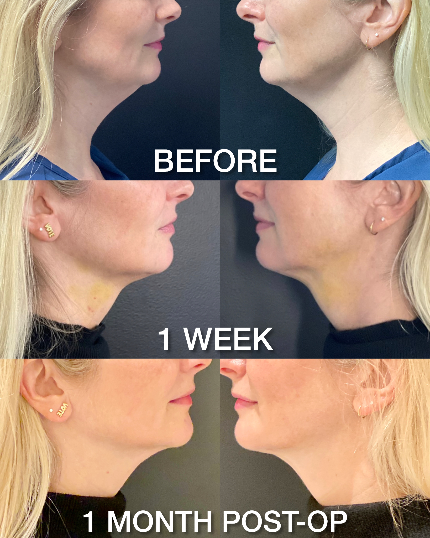 Neck Rejuvenation Before and After Results
